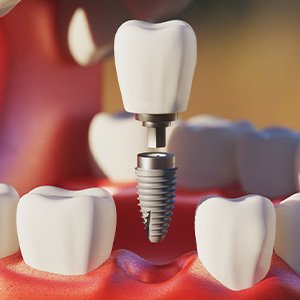 Digital image of the dental implant parts