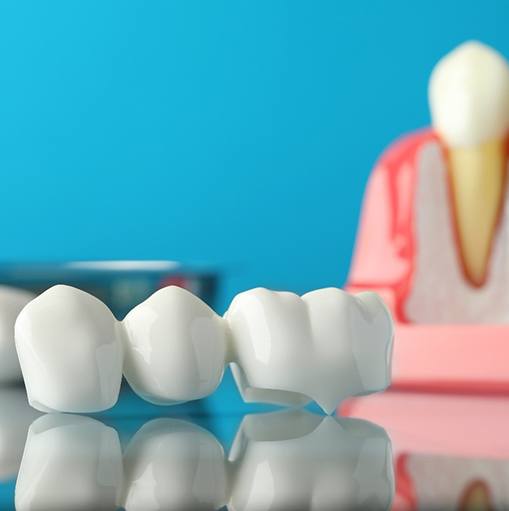 Dental bridge on reflective surface in front of model dental implants