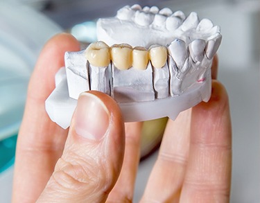 Hand holding cast of lower arch with dental bridge on it