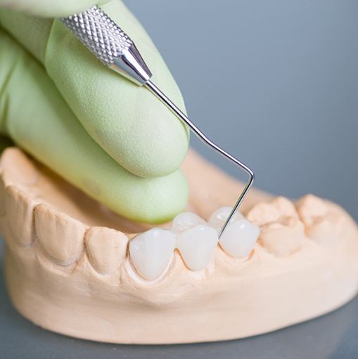 Green gloved hand poking dental bridge on model teeth