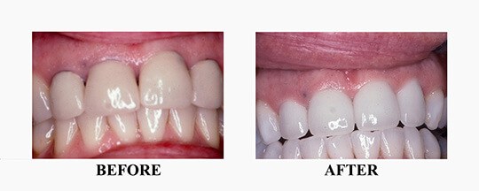 Before/After Photo of Teeth Whitening Case