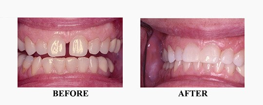 Before/After Photo of Tooth Colored Filling Case