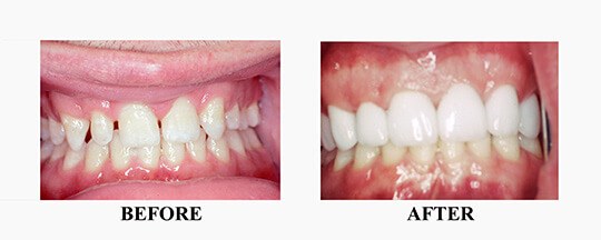 Before/After of Porcelain Veneer Case 1