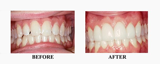 Before/After of Porcelain Veneer Case 2