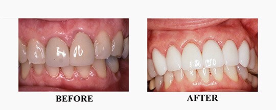 Before/After of Porcelain Veneer Case 3