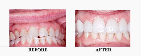 Before/After of Porcelain Veneer Case 4