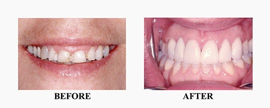 Before/After of Porcelain Veneer Case 5