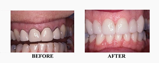 Before/After Photo of Dental Crown Case