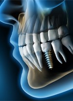 X-ray of a person with a dental implant in Norwood 