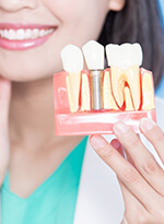 dentist showing a dental implant model 