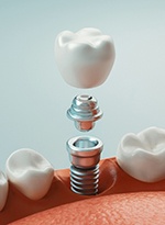 Dental implant in Norwood, MA for lower arch
