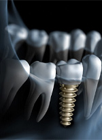 Digital illustration of dental implant in Norwood