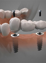 Dental implant bridge in Norwood