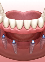 Digital illustration of dental implant denture in Norwood