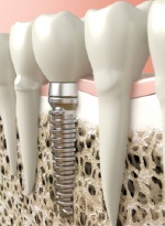 A diagram of a dental implant.