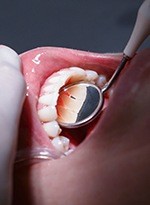Closeup of teeth during dental treatment