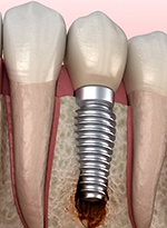 Illustration of a failed dental implant in Norwood, MA with bone loss