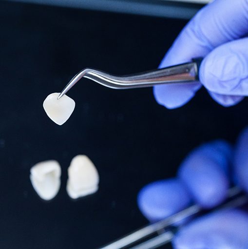 Gloved hands grabbing veneers with dental tweezers