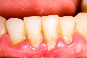 teeth and gums with tartar buildup