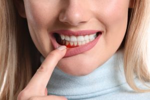 Woman showing signs of gum disease in Norwood