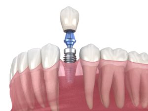Model of single dental implant