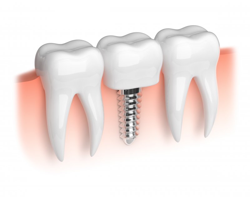 3-D diagram of a dental implant